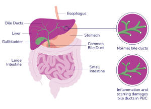 Medical diagram depicting the Oesophagus, Bile Ducts, Liver, Gallbladder, Large Intestine, Small Intestine, Common Bile Duct and Stomach. It includes two closeup sections, one showing normal bile ducts, the other shows how
inflammation and scarring damages bile ducts in PBC.
